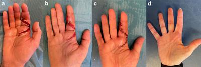 Legionella longbeachae wound infection: case report and review of reported Legionella wound infections